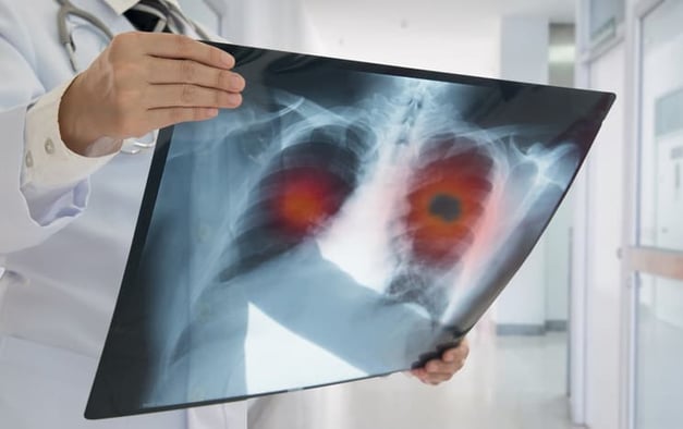 New Blood-Based RNA Platform for Early Lung Cancer Diagnosis