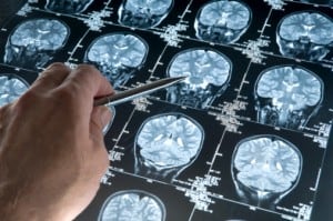 Brain Scan Before Antidepressant Therapy May Predict Response