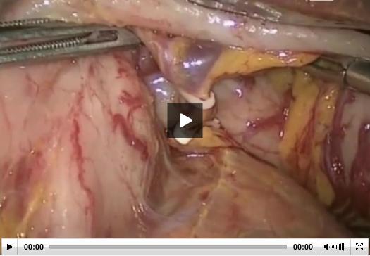 Laparoscopic Pancreatectomy