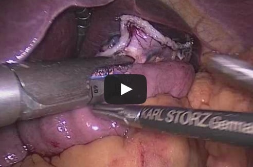 Laparoscopic Roux-en-Y Gastric Bypass