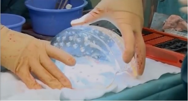 Neurosurgeons Successfully Implant 3D-Printed Skull