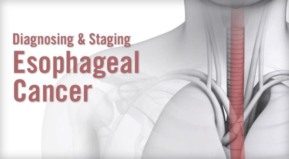 Diagnosing & Staging Esophageal Cancer