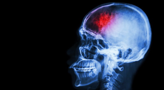 Increasing Awareness of Pott’s Puffy Tumor: ‘What Clinicians Need to Know’