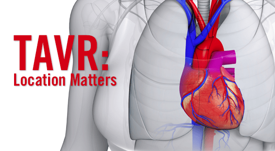 Comparing Where TAVR is Performed