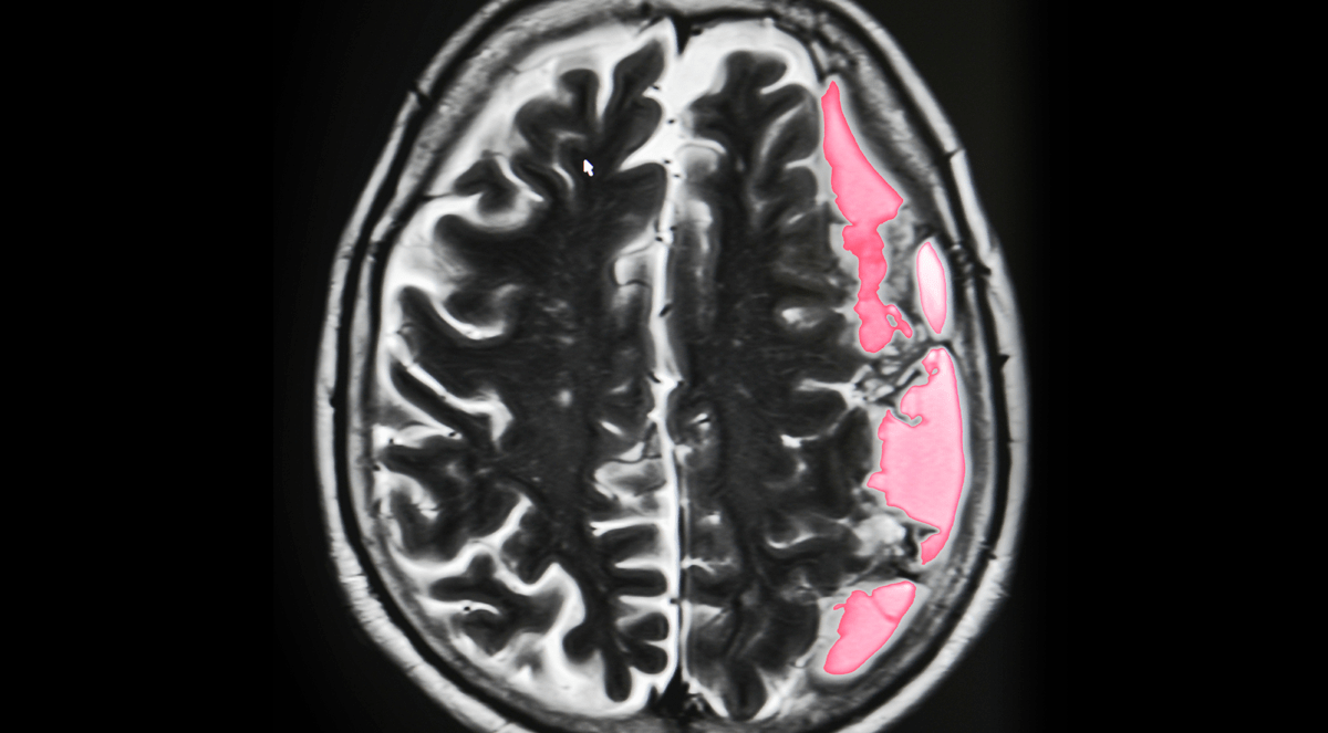 Unmet Full Coma Scale: Evaluating its Profound Impact in Patients with Mild SDH