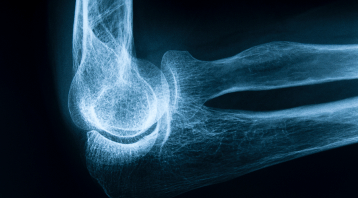 Osteoporosis-Related Bone Fractures Linked to Air Pollution