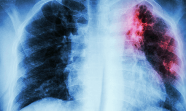 Three New Lung Cancer Genetic Biomarkers Identified