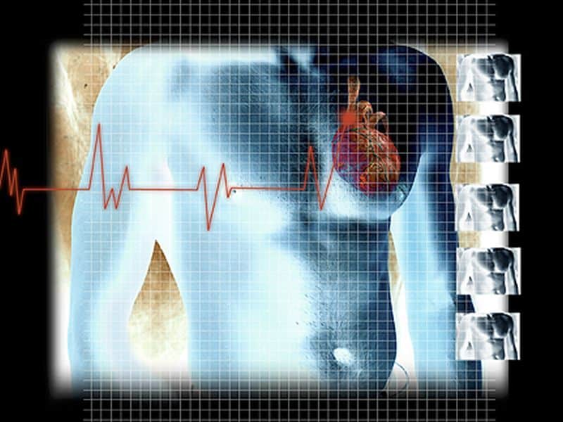 AI Can Identify Model of Cardiac Rhythm Device From Chest X-Ray