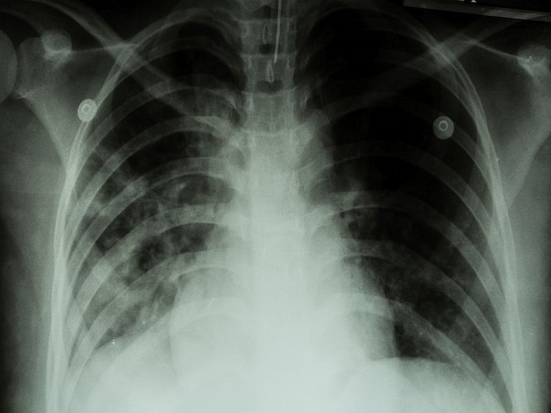 Trauma Center Level & Chest Wall Instability in Patients