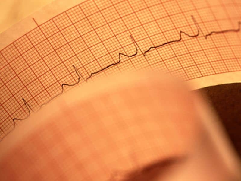 Computer Model Predicts Risk for Ventricular Arrhythmia in ARVC