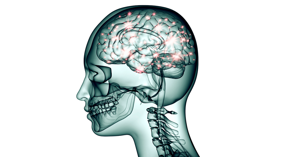 Migraine and aura triggered by normobaric hypoxia.