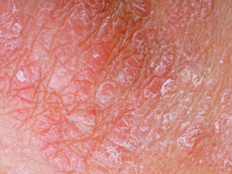 Women Have a Statistically Significant Lower Incidence of Severe Psoriasis Compared to Men