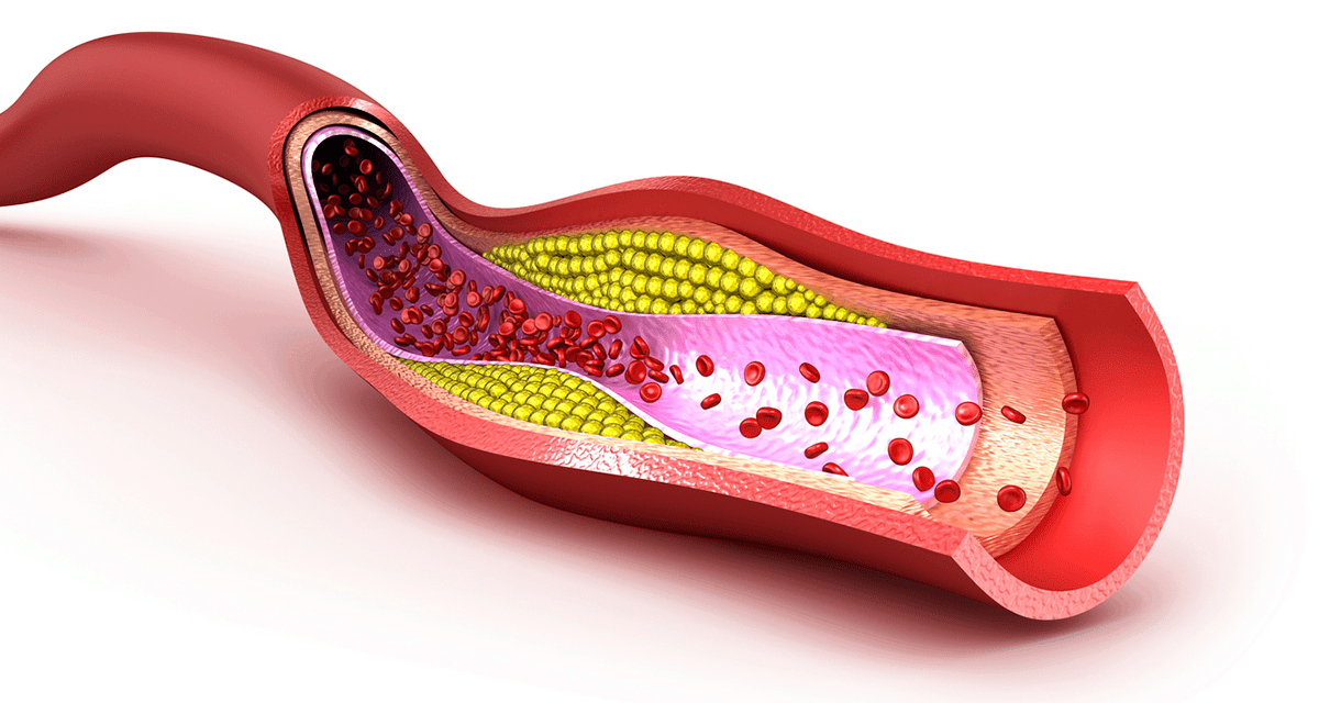 High Levels of ‘Good’ Cholesterol Linked to Excessive Mortality