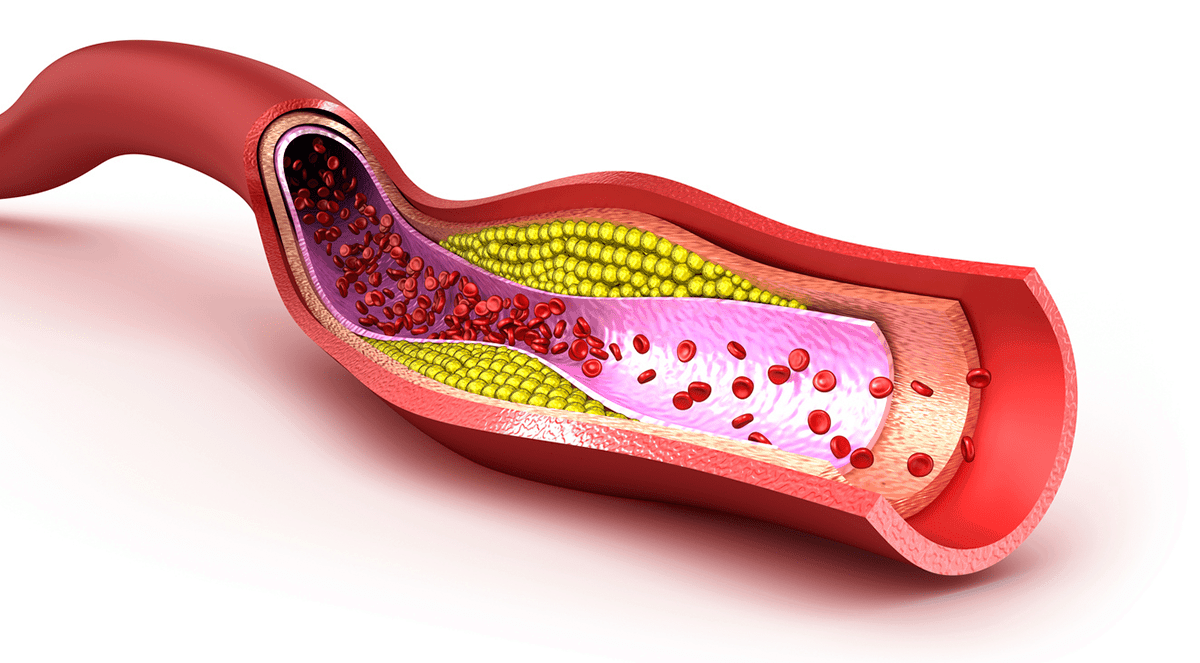 Food Insecurity (FIS) and Dyslipidemia