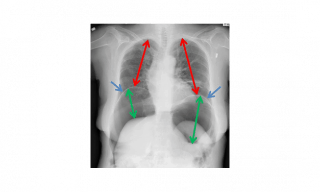 Bladder catheter + oxygen supply tubing = death