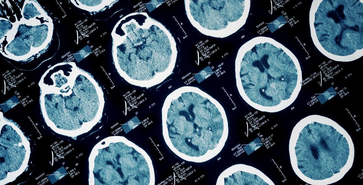 Orthostatic Headache in Children Including Postural Tachycardia Syndrome and Orthostatic Hypotension: A Near-Infrared Spectroscopy Study.