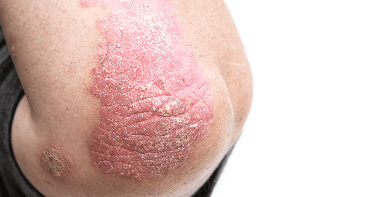 Psoriasis & Cardiovascular Events