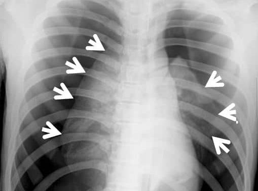 Bilateral pneumothoraces after acupuncture