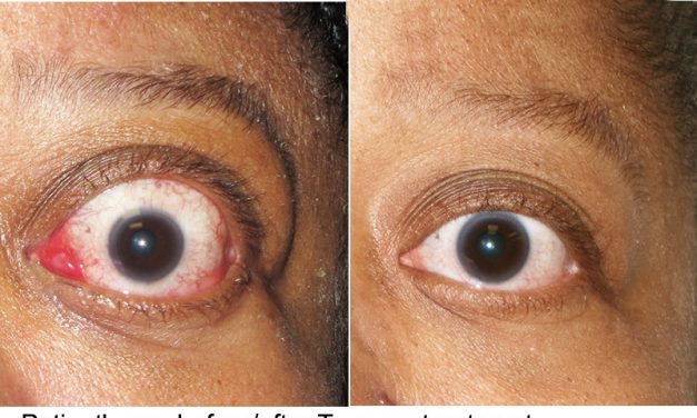 Corneal Endothelial Changes in Congenital Glaucoma Patients