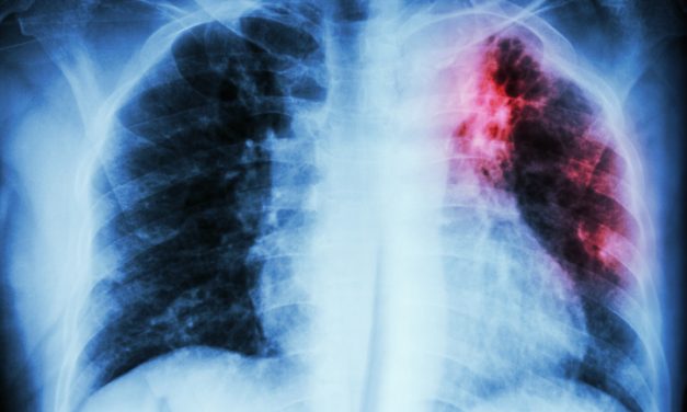 AI Algorithm Can Detect COVID-19 on Chest X-Rays