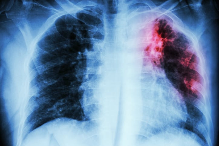 AI Algorithm Can Detect COVID-19 on Chest X-Rays