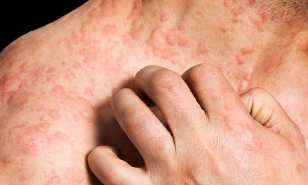 Nemolizumab Beats Placebo for Reduction of Pruritus in Eczema