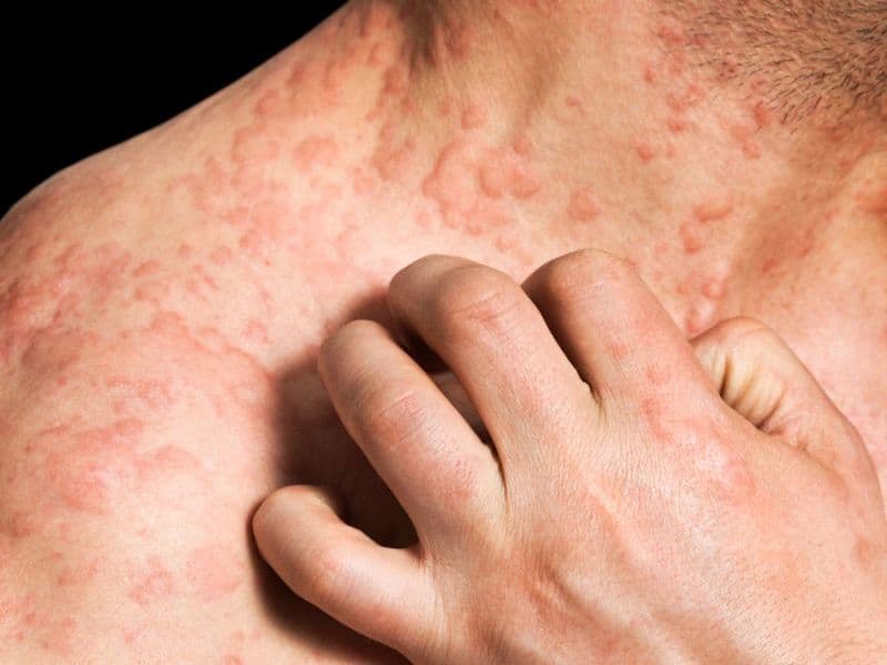 Nemolizumab Beats Placebo for Reduction of Pruritus in Eczema