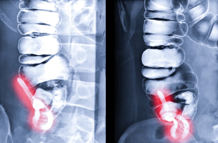 Acute appendicitis: Will a novel endoscopic “organ-sparing” approach change the treatment paradigm?