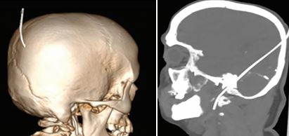 Unusual Cases Part 7: Growing Hair…and a Guidewire