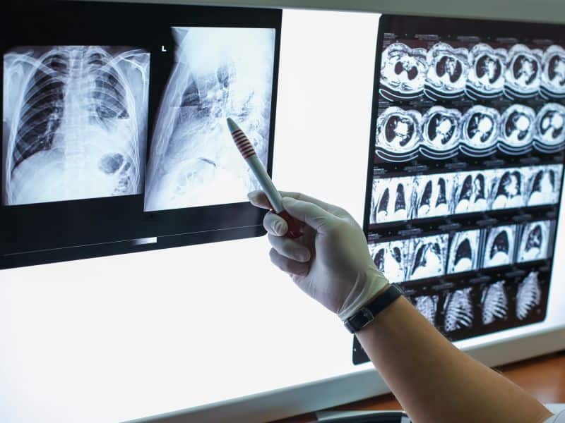 Comparing Midazolam and Morphine Effects in ACPE and COPD