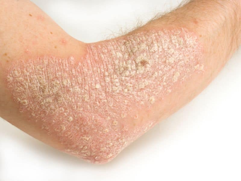 Depression Common Among Psoriasis Patients