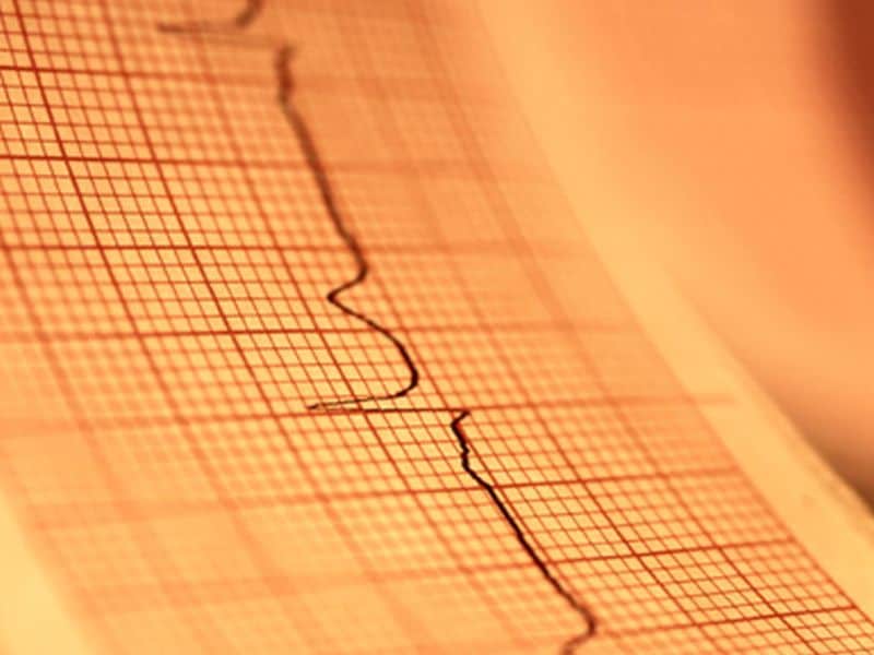 Ertugliflozin Noninferior for CV Outcomes in T2DM With ASCVD