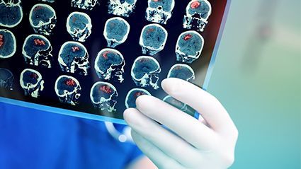 Circulating Metabolites Linked to Risk for Incident Stroke