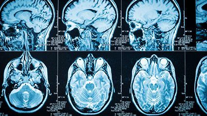 Dexamethasone May Hinder Immunotherapy for Glioblastoma