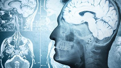 Multifocal Microvascular Injury ID’d in Brain in COVID-19