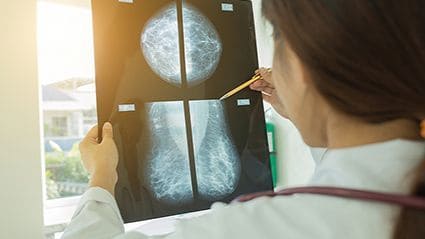 Mammography Guidelines Developed for Older Breast Cancer Survivors