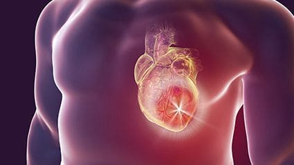 Cocaine Use, HIV Affect Coronary Plaque Morphology