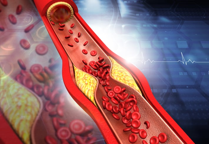 Greater Need Exists for Early Recognition of Elevated Cholesterol