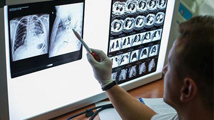 Calcium Scores From Low-Dose Lung CT Can Predict CVD Mortality