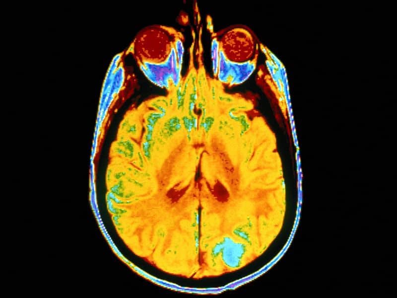 AI Model Detects Normal, Abnormal Findings on Brain MRI