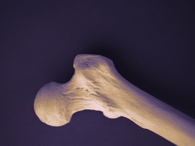 Low Bone Mineral Density Prognostic for Atherosclerotic CVD