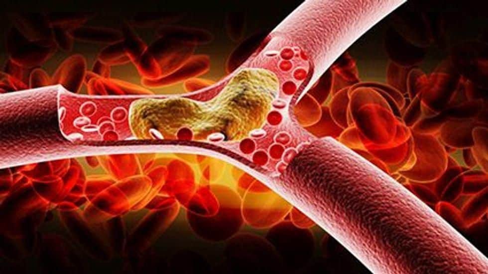 More Clot Retrieval Attempts May Worsen Stroke Outcome