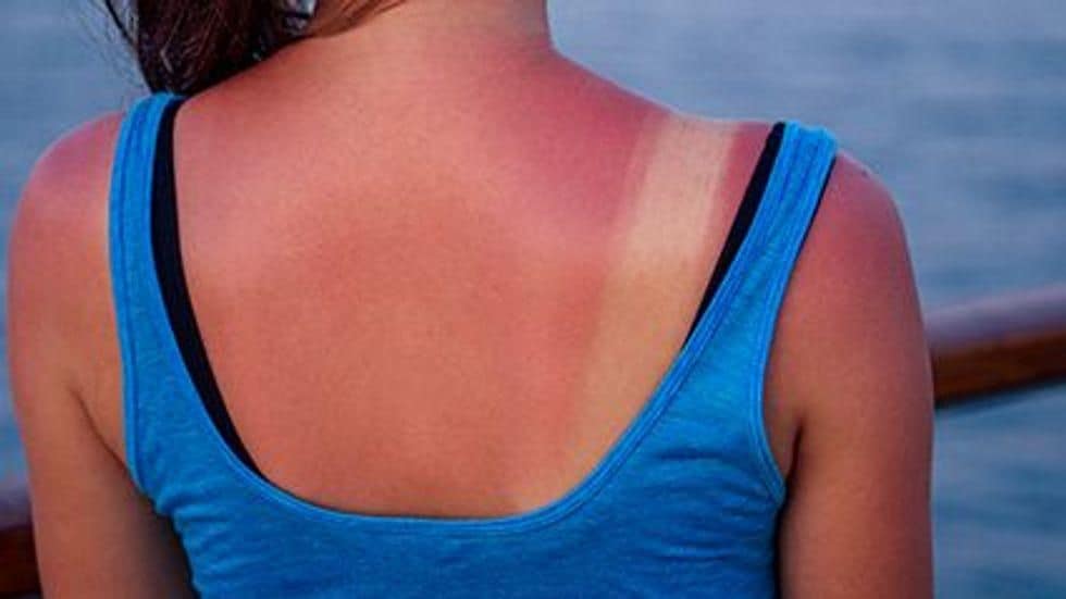 Health Care Visits for Sunburn Are Rare