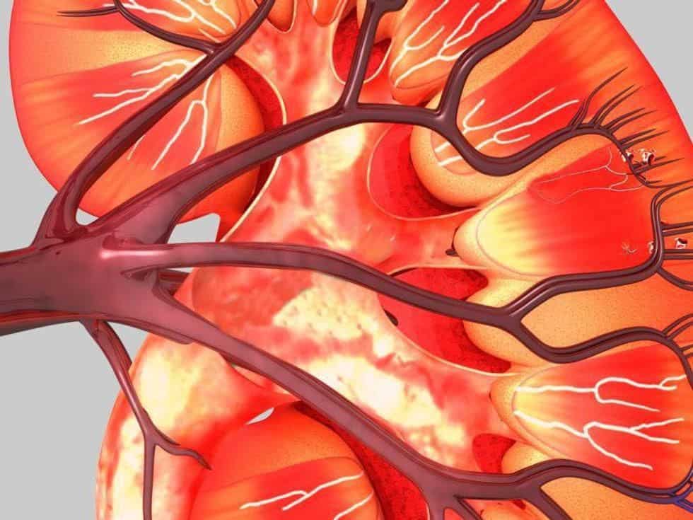 Pharmacomechanical Thrombolysis for Acute DVT Tied to Kidney Injury