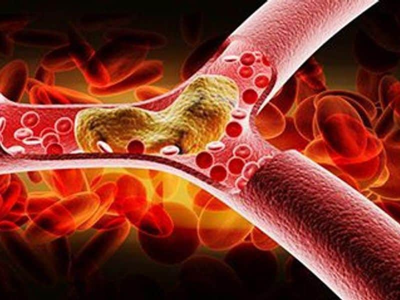 Noncontrast CT Can ID Candidates for Mechanical Thrombectomy