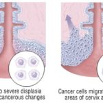 Cemiplimab treatment of recurrent cervical cancer is associated with longer overall survival