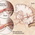 Endovascular therapy improves functional outcomes in large acute ischemic stroke patients