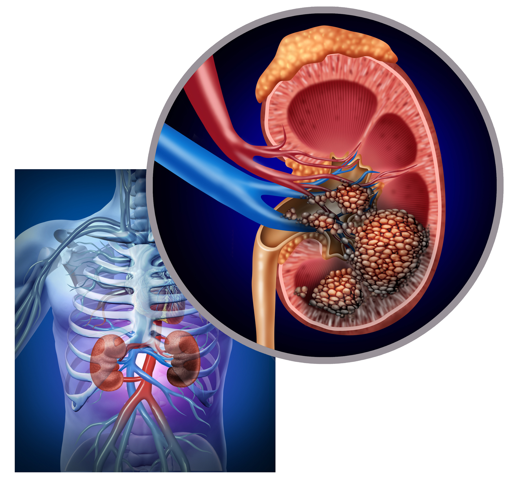 Cardiovascular Death Epidemiology in Renal Failure