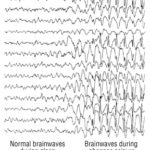 Treatment of rhythmic and periodic EEG patterns in comatose survivors of cardiac arrest