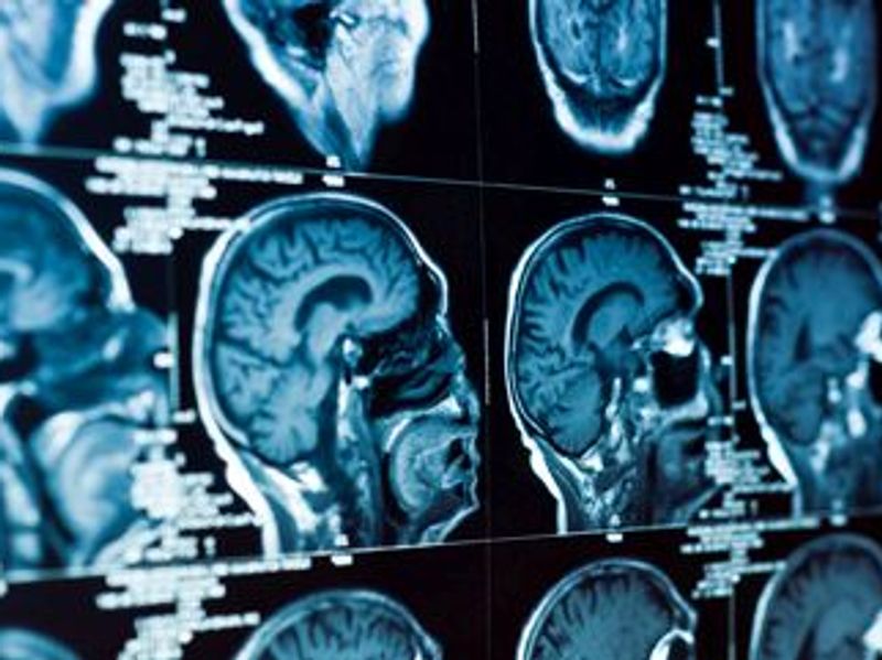 Early Posttraumatic Seizures Tied to Worse Traumatic Brain Injury Outcomes